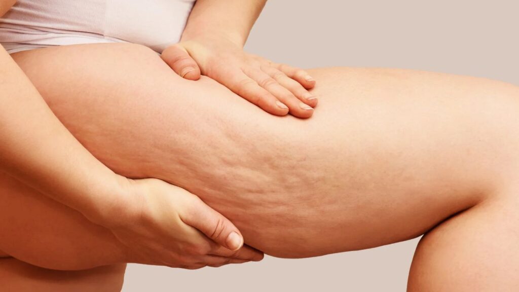 Bein einer Frau mit Cellulite Dellen